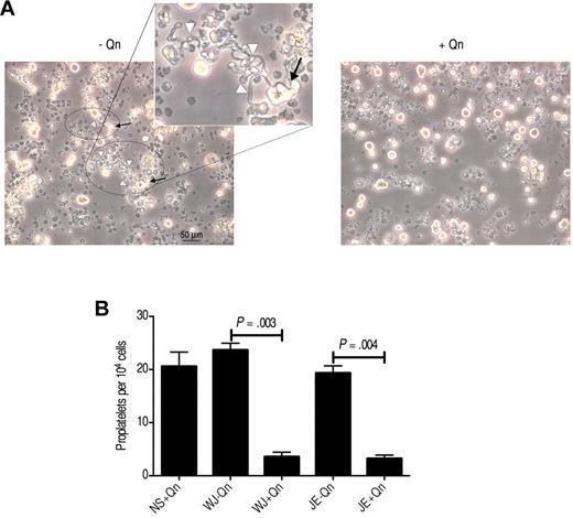 Figure 7. Reduced proplatelet production by QITP antibodies in the presence of quinine. CD34+ cells were cultured for 5-6 days, and then seeded for treatment with QITP sera plus Qn or with controls (QITP sera − Qn or NS + Qn) and analyzed after 5 or 6 days in culture. (A) Representative image of typical morphologic features of proplatelets taken with a Leica DMIRB inverted microscope (20× objective using a DC200 camera; Leica). Areas containing proplatelets are circled, with proplatelet-bearing Mks indicated by arrows and proplatelet extensions indicated by white arrowheads (see inset for representative features of proplatelets). Bar indicates 50 μm. The images were cropped and revised using Adobe Photoshop CS5. (B) Proplatelets were enumerated and are presented as the number of proplatelets ± SD per 104 cells. Treatment with QITP sera + Qn significantly reduced proplatelet production.