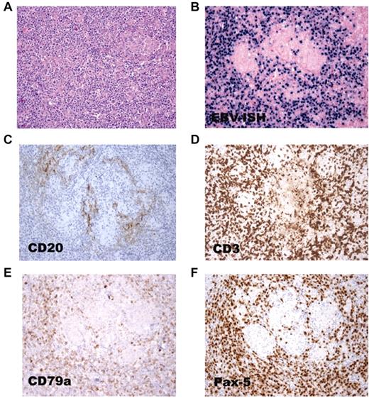Figure 1. EBV RNA in both CD20+ and CD20− B cells in a lymph node from patient 16. (A) Lymph node biopsy shows polymorphic B-cell lymphoma. (B) In situ hybridization shows that the tumor cells are positive for EBER. Few cells express the CD20 B-cell marker (C), whereas many cells express the CD3 T-cell (D), CD79 B-cell (E), and Pax-5 B-cell (F) markers.