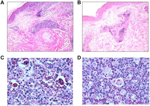 Figure 2. EBV disease involving skin, lymph nodes, and spleen. Skin from patient 12 shows a perivascular lymphocytic infiltrate (A) that is positive for EBER (B). Lymph node (C) and spleen (D) with hemophagocytosis from patient 9.