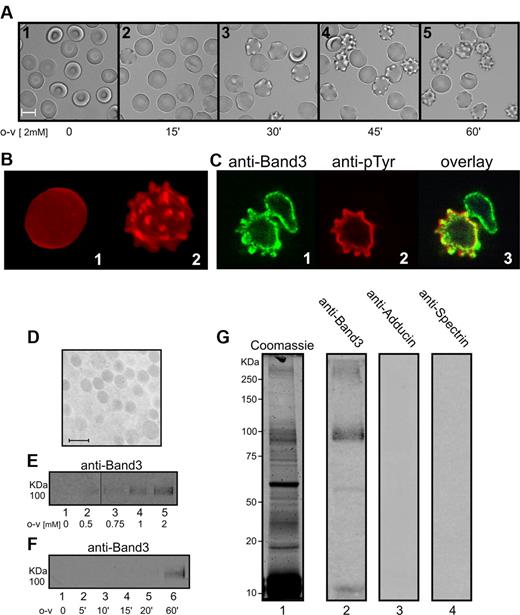 Figure 4. Analysis of the effect of o-vanadate treatment on erythrocyte morphology and vesicle release. (A) Images of 2mM o-vanadate–treated (o-v) erythrocytes at different incubation times. (B) Confocal fluorescence microscopy images (maximum intensity projections) of DiI-labeled untreated erythrocytes (panel 1) and 2mM o-vanadate–treated erythrocytes (panel 2), both at 60 minutes. (C) Confocal microscopy images of erythrocytes treated with 2mM o-vanadate for 1 hour, erythrocytes labeled with anti–band 3 (panel 1) and anti-phosphotyrosine (anti-pTyr; panel 2) antibodies, and an overlay image (panel 3). (D) Electron microscopy image of the vesicles released from o-vanadate–treated erythrocytes. Ultrathin sections were stained with osmium tetroxide, examined, and photographed using a Zeiss EM 900 transmission electron microscope operating at 80 KV. Bar indicates 1 μm. Vesicles released from erythrocytes treated with increasing o-vanadate (o-v) concentrations (E) or with 2mM o-vanadate for different incubation times (F) were collected by ultracentrifugation from the supernatants of cells incubated at 42°C for 45 minutes. The amount of released vesicles was estimated by measuring band 3 using anti–band 3 Western blotting. Vesicle proteins obtained from o-vanadate–treated erythrocytes were separated by 8% SDS-PAGE under reducing conditions. Gels were stained with Coomassie (lane 1) or transferred to nitrocellulose and immunostained with anti–band 3 (lane 2), anti-adducin (lane 3), and anti-spectrin (lane 4) antibodies (G). Images were acquired using a laser infrared fluorescence detector (Odyssey; LI-COR Biosciences).