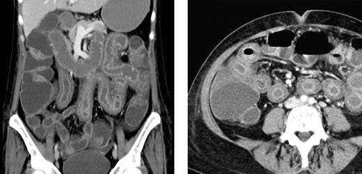 Figure 2. Abdominal CT scan of a patient with NV GE. Extensive bowel edema in a patient with NV GE acquired during BEAM conditioning chemotherapy for autologous HSCT. The bowel wall edema was restricted to the small intestine, and the colon showed only a moderate dilation.