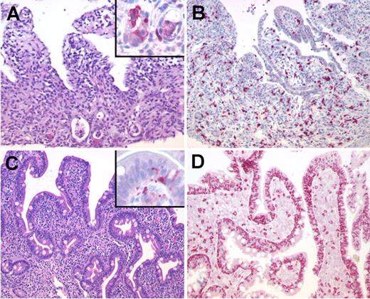 Figure 3. Sequential duodenal biopsies from a patient with allogeneic HSCT. (A) Duodenal biopsy with severe GVHD showing partial loss of surface epithelium (H&E) and increased numbers of apoptotic crypt epithelial cells (inset: cleaved caspase-3 staining showing apoptotic epithelial cells at the base of crypts). (B) Predominance of CD8+ T cells in the lamina propria with focal infiltration of the crypt epithelium (immunohistochemistry, APAAP method). (C) In contrast, duodenal biopsy in the same patient during NV infection shows villous blunting (H&E) and only a slight increase of apoptotic epithelial cells at the tip of the villi (inset: cleaved caspase-3) and (D) a massive increase of intraepithelial CD8+ T cells pronounced in the surface epithelium. Original magnifications, ×200 and ×600 (inset). Microscope: Olympus AX70 (Olympus); numeric aperture of objective lenses: ×20, 0.70 mm; ×60, 1.40. Stains: H&E (panels A and C); APAAP and streptavidin AP (panels B and D, inset). Camera: JVC KY-F70 (JVC); acquisition software: DISKUS; and software used for image processing: Adobe Photoshop 7.0 (Adobe Systems).