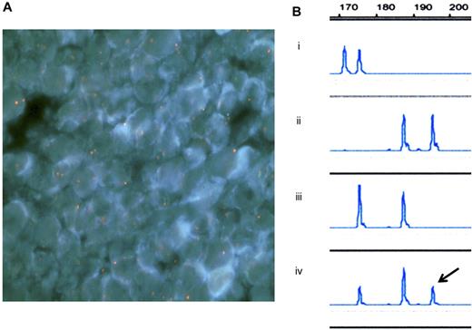 Figure 1. Fluorescence in situ hybridization (FISH) analysis of the infant's tumor tissue (a resected sample) and microsatellite analysis. (A) FISH analysis with probes for X (red) and Y (green) chromosomes showed the chimeric pattern; XX in tumor tissue and XY in normal tissue. Image acquisition information: Olympus BX-51 microscope; UPlanApo 100×/1.35 oil objective; DAPI nuclear stain; Nikon DXM1200 camera. (B) Microsatellite analysis on chromosome 3 was carried out using DNA samples extracted from (1) the father's peripheral blood, (2) the mother's bone marrow film, (3) the infant's peripheral blood, and (4) the infant's tumor tissue (a resected sample). The resected tumor tissue had 3 peaks and the right one (arrow) was the noninherited maternal DNA marker. Analysis of the peak height indicated that 55% of the resected tissue was of maternal origin.