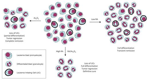 Figure 2. A revised model of treatment outcomes in APL. Low RA doses (right) induce differentiation of the bulk of the tumor without affecting the LICs, leading to transient clinical responses but no cure in patients. Arsenic treatment (left) entails some differentiation and substantial loss of LICs, resulting in tumor regression and durable remissions with a high proportion of definitively cured patients. The combination of arsenic and RA, as well as high RA concentrations (bottom) elicit both complete differentiation of leukemia blasts and eradication of LICs, thus leading to strong tumor regression and ultimately to cure in most patients.