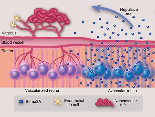It has long been appreciated that there is a deficiency in revascularization of ischemic retina even though there is robust pathologic neovascularization into the vitreous, a region of the eye normally devoid of blood vessels. Experiments by Joyal and colleagues suggest that ganglion cells in the avascular retina secrete Semaphorin 3A, which acts as a repulsive force against revascularization of the ischemic retina and directs neovessels toward the vitreous to form pathologic neovascular tufts. Professional illustration by Marie Dauenheimer.