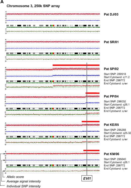 Figure 1. SNP characterization and RT-PCR analysis of 3q gains in FA. (A) SNP array characterization of 3q gains in all FA bone marrow harvests. SNP array data are visualized using CNAG 3.0 software. Analysis of call intensity was conducted using standard Affymetrix analysis software algorithms provided in GCOS and GTYPE 4.0. Chromosomal aberrations were analyzed using Copy Number Analyzer for Affymetrix GeneChip Mapping arrays (CNAG) 3.0 software employing the AsCNAR algorithm. In 4 patients with 3q gain, the extension of aberration is depicted using red bars and the position coordinates are shown on the right side. Position of EVI1 is indicated. (B-I) qRT-PCR analysis of selected genes as indicated (B: EVI1; C: TERC; D: PAK2; E: SKIL; F: PIK3CA; G: EIF-4G1; H: FXR1; I: DCUN1D1) in FA bone marrow samples with 3q-gains (darker-shaded right 4 columns) and without (brighter-shaded left 2 columns). Transcripts levels are shown as 2−ΔΔCt normalized to normal BM (*P below graph) using β-actin and SDHA as housekeeper genes. Comparison also between mean transcript levels of FA marrows with and without 3q gains (t test).