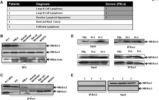 Figure 2. Interaction of endogenous Bcl-2 with Rac1 in primary tumor tissue. (A) Table representing the different patient samples used in the analysis. (B) Whole cell lysates (WCL) from primary tissue derived from patient 1 (B-cell lymphoma), PBLs from healthy donor, IMR90 human fibroblasts, rat L6 smooth muscle cell fibroblasts, and mouse NIH3T3 fibroblasts were analyzed for the expression of Rac1 and Bcl-2 (C-2, Santa Cruz Biotechnology). (C) Cell lysates were immunoprecipitated with anti-Rac1 and probed with anti–Bcl-2 and anti-Rac1 (as internal control). (D) Cell lysates from clinical material (patients 2-5) and PBLs were immunoprecipitated with anti-Rac1 and probed with anti–Bcl-2 using Western blot analysis. (E) Cell lysates from PBLs from 3 healthy donors were immunoprecipitated with anti–Bcl-2 and probed with anti-Rac1.