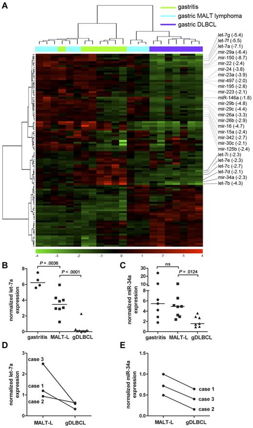 Figure 1. A Myc-repressed miRNA signature distinguishes gastric DLBCL from low-grade MALT lymphoma. (A) The expression of 795 human mature miRNAsincluded in Version 10.0 of the miRBase database was analyzed for 7 cases of gastritis (green), 8 cases of low-grade MALT lymphoma (MALT-L; blue), and 7 gDLBCL cases (purple) with the use of microarray technology. The result of unsupervised hierarchical clustering of all miRNAs that varied across the 22 arrays with a standard deviation of log2 expression > 0.05 is shown in the heat diagram. All known Myc-repressed miRNAs with lower expression in gDLBCL compared with low-grade MALT-L are annotated along with their fold change in expression (averaged across groups) between gDLBCL and MALT-L (in brackets). (B-C) Quantification of let-7a (B) and miR-34a (C) expression in the samples shown in panel A by LNA real-time RT-PCR; absolute expression was normalized to U6 snRNA. P values were calculated by unpaired t test. Horizontal lines represent median values. (D-E) Quantification of let-7a (D) and miR-34a (E) expression in matched MALT-L and gDLBCL samples from 3 patients with gastric lymphoma.