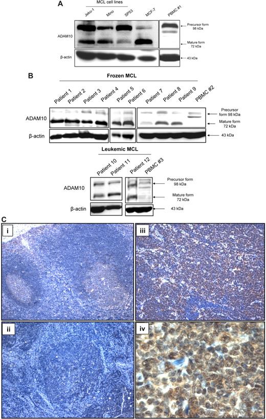 Figure 1. ADAM10 expression in MCL cell lines and patient samples. (A) Western blots showing the expression of the precursor and active/mature forms of ADAM10 in 3 MCL cell lines. Whereas the precursor was highly expressed, the active/mature form was readily detectable only in Jeko-1 and Mino cells. A faint band at 72 kDa, representing the active/mature form of ADAM10, was also detectable in SP53. MCF-7 cells were used as the positive control. PBMCs from a healthy individual (PBMC #1) showed abundant precursor ADAM10 protein but no detectable active/mature ADAM10. (B) Western blots showing the presence of the precursor and active/mature form of ADAM10 in all MCL patient samples (both frozen #1-9 and leukemic #10-12); PBMCs from 2 healthy individuals (#2 and #3) showed no detectable active/mature ADAM10. (C) Immunohistochemistry showing no detectable signal of ADAM10 in the mantle zone of a reactive tonsil. At 100× magnification, the germinal centers showed faint staining (i), one case of MCL tumor showed no detectable ADAM10 (ii), and another MCL tumor showed a relatively high level of ADAM10 expression (iii). On high magnification (1000×), the ADAM10 immunostaining pattern was detectable in both of the nucleus and cytoplasm (iv).