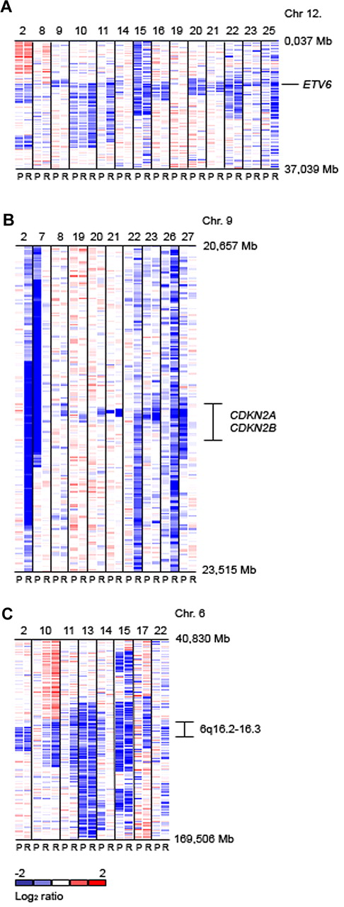 Figure 1. Log2 ratio SNP 500K copy number data (median smoothed with a window of 5 markers; blue is loss and red is gain). (A) Genomic copy number of chromosome 12p flanking ETV6 for 14 representative cases showing deletions at this locus at presentation (P) and relapse (R). (B) Copy number of chromosome 9p flanking CDKN2A/B. (C) Copy number of chromosome 6q. The chromosomal region of 6q16.2-3 which is recurrently deleted in pediatric ALL is indicated.