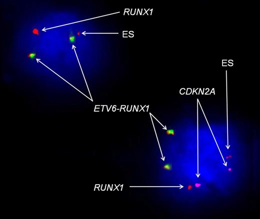 Figure 2. FISH analysis of UPN2 at presentation, using the LSI TEL/AML1 ES Dual-Color translocation probe (Vysis) and CDKN2A probe. The red signal represents the RUNX1 probe; green, the ETV6 probe; yellow, the ETV6-RUNX1 fusion gene; and purple, the CDKN2A probe. This image represents 2 different leukemic cells at presentation. The cell in the right bottom corner represents the dominant leukemic clone (according to the SNP array data analysis), with duplicated fusion gene, loss of wild-type ETV6, 2 copies of CDKN2A, 1 normal RUNX1, and 1 ES (72% of total cells analyzed). In the left top corner FISH analysis identified a leukemic cell with a constellation of signals corresponding to the dominant relapse clone, that is, a duplicated fusion gene, loss of wild-type ETV6, 1 normal RUNX1, 1 ES, and complete loss of CDKN2A (0.4% of total cells analyzed). In control experiments with normal blood lymphocytes from 5 donors, using the same probe combination, this CNA pattern was not observed in any cells (< 0.2%).