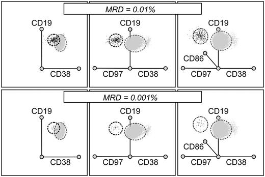 Figure 6. Additional leukemia-associated markers improve resolution of MRD. Files containing flow cytometric data from 5 nonleukemic BM samples cells (gray dots) and one diagnostic ALL sample (black dots) were merged and analyzed as radial plots using the Kaluza software after selecting all CD19+CD10+CD34+ cells. Mixtures containing 0.01% ALL cells (top row) and 0.001% ALL cells (bottom row) are shown. Underexpression of CD38 alone, a standard MRD marker, could not discriminate well between ALL cells and normal CD19+ CD10+ CD34+ cells (left panels) in this case; the discrimination was improved by analyzing expression of CD97 (middle panels), and further improved by the inclusion of CD86 and the use of a 3-dimensional space (right panels).