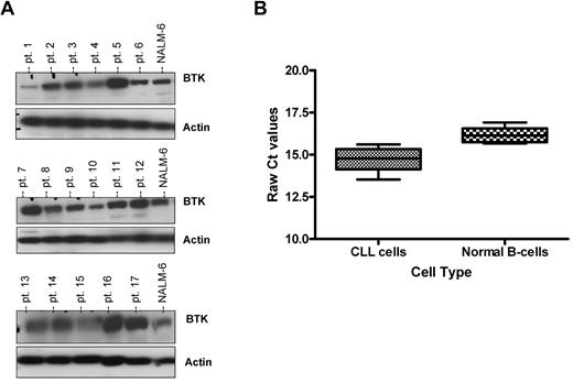 Figure 1. BTK protein but not mRNA expression is highly variable among CLL patients. (A) CD19+ cells from CLL patients (N = 30) were examined for BTK expression by immunoblot. Results are shown from 3 of 6 experiments. (B) RNA was extracted and converted to cDNA from CD19+ cells from CLL patients (N = 18) and CD19+ normal B cells (N = 5). RT-PCR analysis was done to determine quantities of BTK mRNA. Ct values are relative to 18S. Higher relative Ct values represent lower gene expression.