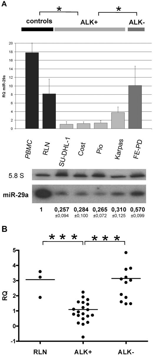 Figure 1. MiR-29a is low expressed in ALK+ ALCL. (A) MiR-29a expression in ALK+ (SU-DHL-1, COST, PIO, Karpas-299) and ALK+ ALCL cells (FE-PD) was analyzed by RT-qPCR and Northern blotting. RNA from reactive lymph node (RLN) and peripheral blood mononuclear cells (PBMC) serve as normal controls. The histogram shows the relative expression (RQ) of miR-29a after normalization with RNU24. Bars represent standard deviations (SD). P for ALK+ vs controls and ALK+ vs ALK− (*P < .05). 5.8S RNA was used as the loading control in the Northern blotting. P for ALK+ vs controls (P < .001) and ALK+ vs ALK− (P < .05). (B) RT-qPCR of miR-29a in 20 ALK+ and 12 ALK− patient tumors. Three RLNs were used as normal controls. RQ was plotted on a logarithmic scale. P for ALK+ vs RLN and ALK+ vs ALK− (***P < .001).