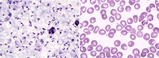 A 2-year-old boy presented to a clinic in rural Mali with fever and malaise. Thick and thin blood films stained with Giemsa (left and right, respectively) revealed that 25.7% of circulating erythrocytes were parasitized with Plasmodium falciparum (273 450 ring-stage parasites per microliter of whole blood). The child had an axillary temperature of 36.9°C and a hemoglobin level of 78 g/L. Eight hours after the first blood smear, a second thin blood film showed 0.6% parasitemia. The child was treated with oral artesunate and amodiaquine over 3 days. Cure was documented on the fourth day by a negative blood smear. / Only ring-stage parasitized erythrocytes circulate in the bloodstream. As ring-stage parasites mature to trophozoites, parasitized erythrocytes sequester by adhering to host endothelial cells in microvessels. In this child, the synchronicity of P falciparum maturation produced a large wave of ring-stage parasitized erythrocytes that were sequestered en masse or removed by the spleen. This case illustrates that individuals with very low or undetectable parasitemia on blood smears may harbor exceedingly high and life-threatening parasite burdens. Of additional interest, this child had sickle cell trait, which may have prevented the development of severe manifestations of malaria.