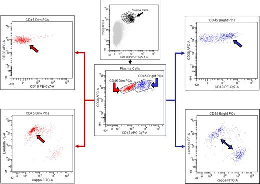 Figure 1. Six-color FC reveals the presence of both abnormal, λ light chain-restricted PCs, and normal, polytypic PCs. Gating on the PCs brightly positive for CD38 and CD138 (upper middle, black arrow) reveals the presence of 2 distinct PC populations as determined by differential expression of CD45 (lower middle). Selective analysis of the PCs with diminished CD45 expression (lower middle, red arrow) reveals that they have abnormal loss of CD19 expression (upper left, red arrow) and have a monotypic staining pattern for λ cytoplasmic immunoglobulin light chains (lower left, red arrow). In contrast, the PCs with relatively brighter CD45 expression (lower middle, blue arrow) express CD19 (upper right, blue arrow) and show polytypic cytoplasmic immunoglobulin light chain expression (lower right, blue arrows).