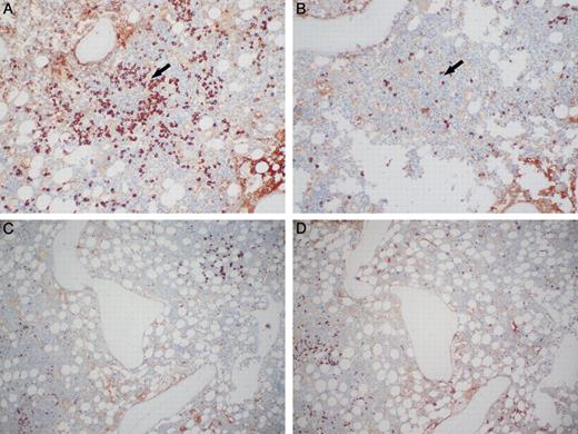 Figure 2. κ and λ light chain immunostaining of monotypic λ PCs in a polytypic background. (A) Lymphoid aggregate (arrow) rimmed by PCs that are monotypic for λ immunoglobulin light chain. (B) PCs are negative for κ immunoglobulin light chains around the lymphoid aggregate (arrow). (C) The same case as panels A and B showing background PCs that are polytypic for immunoglobulin lights chains, λ, and (D) κ. Photomicrographic images were obtained with an Olympus BX51 microscope equipped with an Olympus DP71 camera and software. Final image preparation was performed with Adobe Photoshop CS2 for panels A and B. Original magnification 10×/0.30 UPlanFL N lens for all panels.