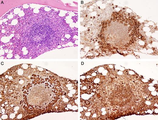 Figure 3. Bone marrow biopsy of lymphoid aggregate rimmed by PCs. (A) The lymphoid aggregate has a regressed germinal center that is Castleman-like (H&E). (B) CD138 positive PCs form a distinctive rim around the lymphoid aggregate. (C) The PCs are monotypic for λ immunoglobulin light chains (D) and negative for κ immunoglobulin light chains by IHC. Photomicrographic images were obtained with an Olympus BX51 microscope equipped with an Olympus DP71 camera and software. Original magnification 20×/0.50 UPlanFL N lens for all panels.