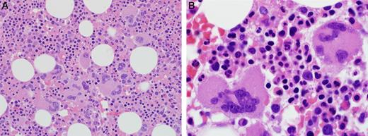 Figure 4. Megakaryocyte clusters and atypical morphology. (Left) Megakaryocyte clusters were a common finding, original magnification ×400. (Right) Cytologically atypical megakaryocytes with abnormal nuclear segmentation and visible nucleoli. Photomicrographic images were obtained with an Olympus BX51 microscope equipped with an Olympus DP71 camera and software. Original magnifications: left panel, 40×/1.30 oil UPlanFL N lens; right panel, 100×/1.40 oil UPlanS Apo lens.