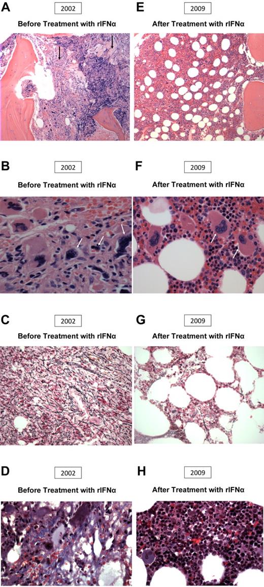 Figure 1. Morphologic change after IFN therapy in a patient with primary myelofibrosis. (A-D) Before treatment (2002). (A) The area of myelofibrosis (left), with preserved residual foci of hematopoiesis, and abnormal megakaryocyte morphology (right). (B) Abnormal megakaryocyte morphology. (C) 2+ reticulin fibrosis. (D) Collagen fibrosis. (E-H) After treatment (2009). (E) Improved bone marrow architecture, hematopoiesis, and megakaryocyte morphology. (F) Improved megakaryocyte morphology and increased normoblastic erythropoiesis. (G) Minimal reticulin fibrosis. (H) Absent collagen fibrosis.