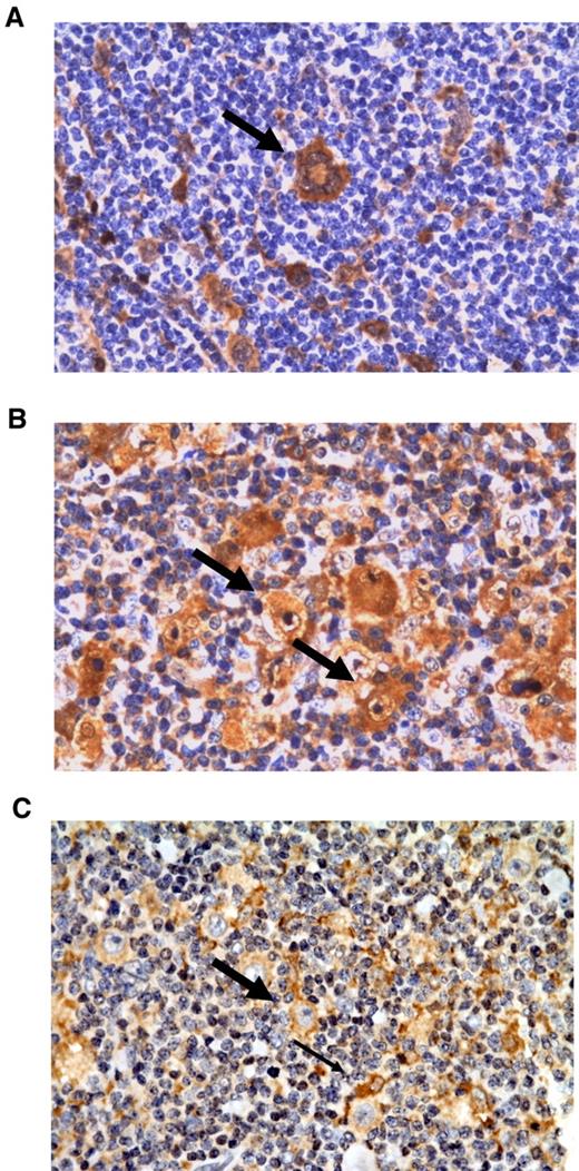 Figure 4. Representative immunohistochemical stainings of the differentially expressed proteins Gal-1, PSME-1, and PRDX-1. (A) Gal-1 staining of a multinuclear HRS cell (thick arrow). (B) PSME-1 staining of HRS cells (thick arrow) and tumor-infiltrating cells. (C) PRDX1 staining showing a positive HRS cell (thick arrow) among PRDX-1–positive macrophages (thin arrow). All magnifications are 400×.