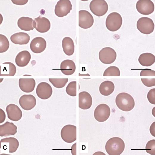 Figure 1. Platelets from THC2 patients have reduced azurophilic granule content. Platelets in peripheral blood smears (May-Grünwald-Giemsa staining) from 4 different probands were normal in size and appeared pale because of reduced content (B,D) or complete absence (A,C) of azurophilic granules. (A) One platelet had a normal granule content. Scale bars represent 10 μm. Images were acquired by an Axioscope 2 Plus microscope (Carl Zeiss) using a 100×/1.30 (oil-immersion) Plan Neofluar objective (Carl Zeiss). The Axiocam MRc5 camera (Carl Zeiss) and Axiovision 4.6 software (Carl Zeiss) were used to capture and process images.