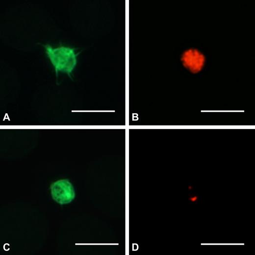 Figure 2. Platelets from THC2 patients have a defect in α-granule content. Peripheral blood smears were stained with the P12 antibody against the α-granule protein TSP1 (red), and platelets were identified by labeling for F-actin (green). (A-B) One platelet from a control subject with normal content in α-granules. (C-D) One representative platelet of a THC2 patient with 2 TSP1+ granules. Scale bars represent 5 μm. Images were acquired as described in Figure 1 legend using a 100×/1.30 Plan Neofluar oil-immersion objective from Carl Zeiss.