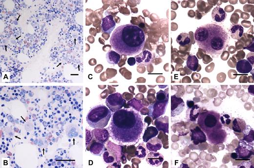 Figure 3. Bone marrow from THC2 patients present an increased number of Mks and dysmegakaryopoiesis. (A-B) Bone marrow biopsy (hematoxylin and eosin staining) of a member of family 4 showed normal cellularity with an increased number of Mks (arrows). Scale bars represent 50 μm. (C-F) Bone marrow smears (May-Grünwald-Giemsa staining) from members of families 8, 11, and 14. Representative examples of small, dystrophic Mks with hypolobulated nuclei and a small amount of mature eosinophilic cytoplasm. Typical micromegakaryocytes (F) were also observed. Scale bars represent 10 μm. Images were acquired as described in Figure 1 legend using a 20×/0.50 Plan Neofluar objective (panels A-B) and a 63×/1.25 Plan Neofluar oil-immersion objective (panels C-F) from Carl Zeiss.