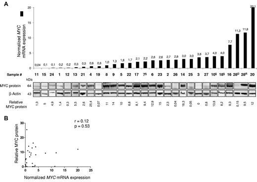 Figure 2. Relationship between MYC transcript levels and MYC protein abundance in primary T-ALL samples. (A) Samples are ordered according to increasing MYC mRNA levels (histograms in top panel, values are indicated above each bar), and the corresponding Western blots are shown below (bottom panel, relative values of MYC protein levels are indicated below each sample). Immunoblotting was performed using anti-MYC and anti–β-actin antibodies. § indicate cases with FBXW7m. (B) Plot showing relative MYC protein versus MYC transcript. Data were analyzed using the Spearman non parametric correlation test; the correlation coefficient (r) is indicated.