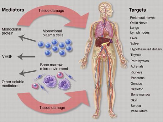The complex relationship of plasma cells, bone marrow microenvironment, soluble mediators, and target organ systems in POEMS syndrome. Professional illustration by Marie Dauenheimer.