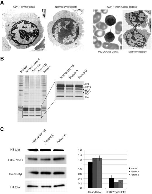 Figure 2. Chromatin structure and composition in CDA-1 patients. (A) Electron microscopy of normal and CDA-1 cultured intermediate erythroblasts, and imaging of intranuclear chromatin bridging stained with May-Grünwald-Giemsa and by electron microscopy. (B) Silver staining of SDS-PAGE of histone extracts from cultured CDA-1 (patients A and B) and normal erythroblasts. (C) Western blots of total histones and histone marks. Quantification of histone marks relative to total histones (set to 1), adjusted to a normalized background.