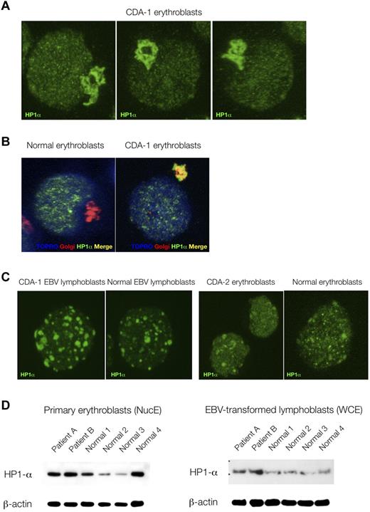 Figure 3. Abnormal accumulation of HP1α in CDA-1 erythroblasts is erythroid specific. (A) Accumulation of HP1α in CDA-1 intermediate erythroblasts by immunofluorescent microscopy. (B) Staining with Golgi-apparatus marker (giantin) confirms localization of HP1α in the Golgi apparatus. (C) Lack of abnormal localization in EBV-derived lymphoblasts from CDA-1 patients and CDA-2 intermediate erythroblasts. (D) Quantification of HP1α in primary erythroblasts and matched EBV-transformed lymphoblasts of CDA-1 patients and controls. Western blotting of nuclear extracts of primary erythroblasts (NucE; left) and of whole-cell extracts of EBV-transformed lymphoblasts (WCE; right).