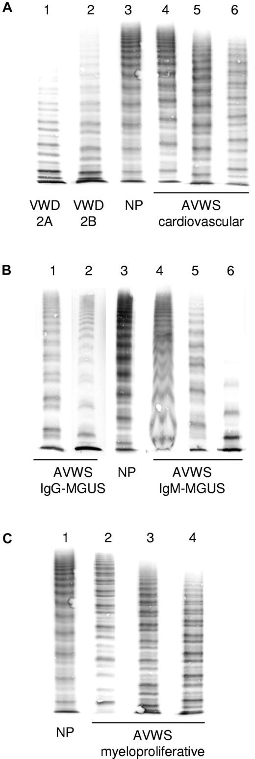 Figure 4. Typical appearance of VWF multimers in AVWS compared with von Willebrand disease. (A) Congenital von Willebrand disease: lane 1 indicates type 2A; lane 2, type 2B; and lane 3 normal plasma (NP). Cardiovascular disorders: lane 4 indicates aortic valve stenosis; lane 5, LVAD; and lane 6, patient on extracorporeal membrane oxygenator (note decrease of HMW multimers). (B) Lymphoproliferative disorders: lanes 1 and 2 indicate IgG-MGUS (note decrease of HMW multimers and relative increase of the lower satellite band within triplets); and lanes 4 to 6, IgM-MGUS (note blurred structure of triplets and loss of HMW multimers in lane 6). (C) Myeloproliferative disorders: lanes 2 to 4 (note variable decrease of HMW multimers and disturbed triplet structure). Lanes have been arranged from different gels and fit for size and staining intensity.
