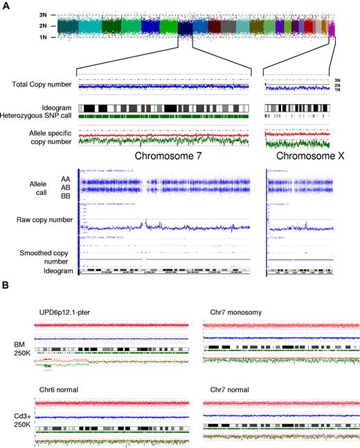 Figure 1. Detection of somatic genomic loss in BM failure syndromes using SNP-A analysis. (A) At the top, a whole-genome view is shown for patient 57. Individual dots represent the raw signal intensity of a specific SNP, which indicates the copy number at that locus. In general, the copy number is around 2N. Each chromosome is represented by a different color, from chromosome 1 on the left to the X chromosome on the right. Loss of chromosome 7, as well as the “physiologic” loss of the X chromosome in this male patient can be seen. At a higher level of resolution, the total and allele-specific copy numbers can be investigated for individual chromosomes. In the middle, Affymetrix 250K array karyograms for chromosomes 7 and X are displayed. The blue line represents smoothed total copy number, while the green ticks below the ideogram represent heterozygous calls. Although both chromosomes 7 and X show a reduced copy number, indicating loss of the entire chromosome, the presence of a large number of heterozygous calls along the length of chromosome 7 is consistent with the clonal nature of this lesion, compared with the X chromosome which has almost no heterozygous calls. Those that remain most likely reflect technical artifacts. At the bottom, karyograms from Affymetrix 6.0 array analysis of the same patient are shown. Raw and smoothed copy number tracks, as well as allele calls (blue dots), are shown. A reduction in the total copy number, as well as loss of heterozygous calls, are seen for both chromosomes, indicative of deletion. (B) Large clonal lesions were detectable in patients with AA by SNP-A. The results are shown for an exemplary patient (no. 96). On the short arm of chromosome 6, loss of heterozygous calls (heterozygous SNP call and allele-specific copy number tracks) with a normal diploid copy number marked a region of copy-neutral loss of heterozygosity in the somatic (BM) but not germline (CD3+) configuration. Similarly, clonal monosomy 7 was identified in this patient.