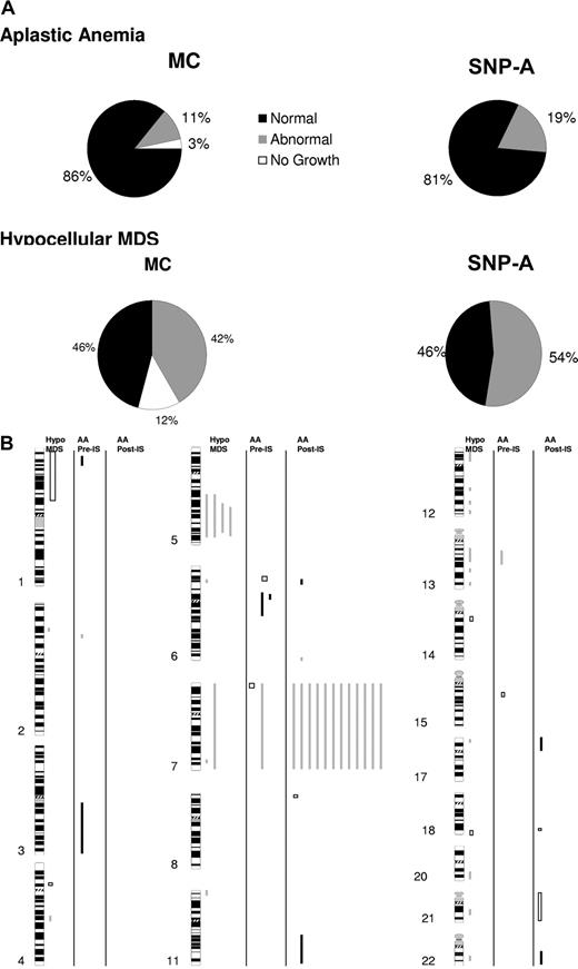 Figure 2. Frequency and genomic distribution of lesions detected by SNP-A. (A) Metaphase karyotyping identified lesions in a subset of patients with AA (top left); however, 3% of the patients had noninformative MC because of failure of growth. When MC and SNP-A karyotyping were combined, the detection rate for chromosomal lesions was increased (top right). In addition, the noninformative cases were resolved. For hMDS, when MC and SNP-A karyotyping were combined, the detection rate for was increased from 42% to 54% (bottom). (B) Genomic distribution of lesions detected by SNP-A in the analyses of hMDS and AA. □ and illustrate genomic gains and losses, respectively. ■ depicts regions of segmental UPD.