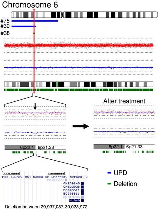 Figure 3. SNP-A identifies genomic regions with potential pathogenic significance in AA. We identified 2 overlapping regions of copy-neutral loss of heterozygosity (blue bars) on the short arm of chromosome 6 in patients with AA; a microdeletion at 6p22.1 (86 KB, green bar) in a third patient defined a minimally affected region (top). This region contained the HLA-A locus. The patient with the microdeletion (no. 48) was treated with immunosuppression. After immunosuppression, the lesion disappeared, confirming the somatic nature of the lesion.