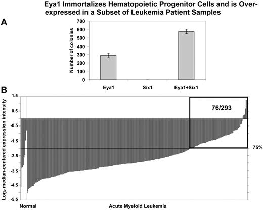 Figure 7. Eya1 immortalizes hematopoietic progenitor cells and is over-expressed in a subset of leukemia patient samples. (A) In vitro colony-forming assays. Primary mouse hematopoietic progenitor cells (HPCs) were transduced with retroviruses encoding Eya1, Six1, and both Eya1 and Six1. Numbers of colonies per dish at the third round of plating are shown (mean ± SD). After serial passage in methylcellulose, HPCs transduced with Eya1 produced tertiary colonies. Although transduction of Six1 by itself was not sufficient to immortalize HPCs, cotransduction with Eya1 resulted in increased tertiary colony formation compared with HPCs transduced with Eya1 alone. (B) Cancer outlier profile analysis (COPA) revealed EYA1 as a gene with outlier expression profile at the 75th percentile in the Valk et al acute myeloid leukemia dataset (n = 293).34 EYA1 expression is shown from all profiled samples in this dataset. The microarray data indicate that EYA1 is highly over-expressed in a subset of AML samples (76/293). The boxed region indicates 76 AML samples with overexpression of EYA1 among 293 patients examined. Visualization tools incorporated in Oncomine were used to generate graphical displays.28 “Normal” group includes 3 CD34+ selected and 5 unselected marrow samples; “Acute Myeloid Leukemia” group includes 285 samples.