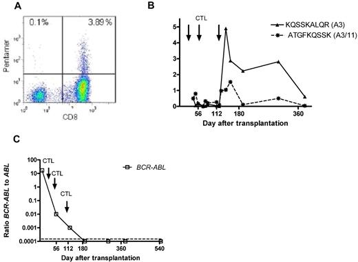 Figure 4. Peptide+/human leukocyte Ag+ CD8+ T cells and B-cell receptor–ABL levels. (A) FACS heat map of KQSSKALQR/human leukocyte Ag-A3 pentamer+ CD8+ T cells detectable in the peripheral blood of patient 9 at 3 weeks after the third infusion of the in vitro-generated CTL preparation. As demonstrated in panel B, this was accompanied by the detection of 1.5% ATGFKQSSK/human leukocyte Ag-A11/-A3 pentamer+ CD8+ T cells. The patient has remained in molecular remission throughout follow-up, with no signs of acute or chronic GVHD (C).