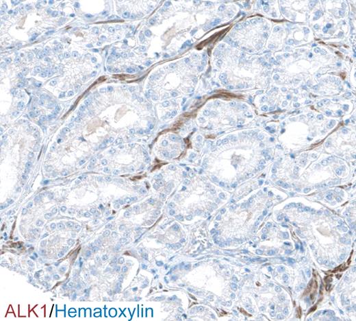 Figure 3. Immunostaining for ALK1 (brown) of a section from human prostate cancer reveals a vascular staining pattern. Cell nuclei are counterstained with hematoxylin (blue). Image taken from the Human Protein Atlas (http://www.proteinatlas.org).