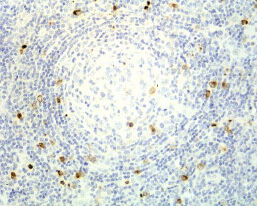 KSHV-infected cells expressing vIL-6 within an adventitious germinal center in a multicentric Castleman disease tumor. Illustration courtesy of C. Parravicini.