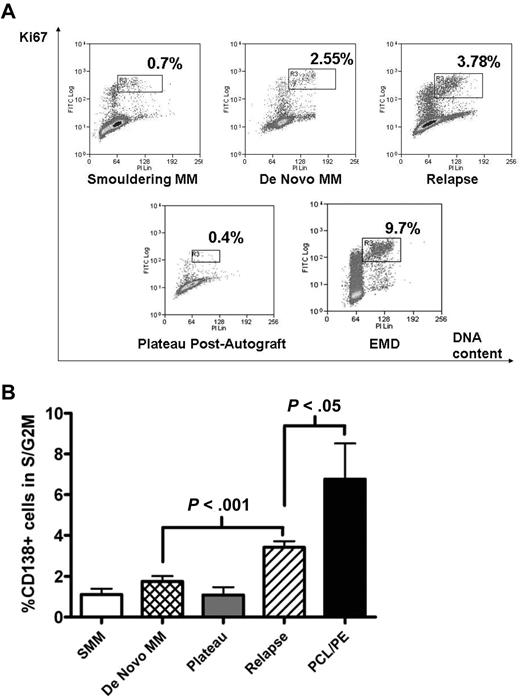 Figure 1. Proliferative fraction of freshly purified CD138+ cells according to disease stage. Freshly isolated MM cells were stained with APC-conjugated anti-CD138, followed by fixation/permeabilization before intracellular staining with FITC-conjugated anti-Ki67 and DNA-staining with PI. Analysis was on CD138+ cells, and the proliferative fraction in S/G2M was gated as shown in panel A, which illustrates representative patients at different disease stages. EMD indicates extramedullary disease. (B) Cumulative data from 143 samples. Data are mean ± SEM for each group: SMM, 4; de novo MM, 31; plateau, 8; relapse, 91; PCL/PE, 9. SMM indicates smouldering MM; PCL/PE, plasma cell leukemia and myelomatous pleural effusion (includes 8 cases with PCL with data from BM CD138+ cells in 5, peripheral blood in 3, and 1 pleural effusion sample). Purified MM cells were used in all cases except for the postautograft cases where mononuclear cells were used.