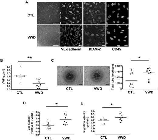 Figure 5. BOECs from patients with VWD show increased in vitro angiogenesis, proliferation, and migration. (A) Representative images of BOECs from a healthy control (top, far left) and a VWD patient (bottom, far left). Colonies appeared after 7-22 days in culture (size bar = 200 μm). BOECs were stained for VE-cadherin, ICAM-2, and CD45. Nuclei were stained with TO-PRO 3 (Invitrogen). Size bar = 20 μm. (B) Secretion of VWF (μg/mL) from cultured BOECs after 48 hours. (C) BOEC were seeded onto Matrigel for 24 hours and capillary network formation was quantified by measuring total tube length in micrometers. Size bar = 200 μm. (D) Proliferation of BOECs cultured with 100 ng/mL VEGF for 96 hours relative to unstimulated controls. (E) Migration velocity of cells at the periphery of endothelial colony prior to the first passage. Each patient is identified with a unique symbol (see supplemental Table 1 for code and information on VWD patients). Error bars indicate mean ± SEM. *P < .05; **P < .01 (Student t test).