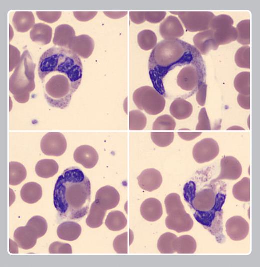A 65-year-old man with diabetes mellitus presented with fever and hematuria for 1 week. His complete blood count showed hemoglobin of 95 g/L, and a normal white count and platelet count. Other tests included an indirect bilirubin of 2.0 mg/dL and lactate dehydrogenase of 2025 U/L. His direct antiglobulin test showed 3+ positivity for immunoglobulin G and C3. A peripheral smear was performed showing approximately 50% of neutrophils with erythrophagocytosis. Donath-Landsteiner test was positive and a diagnosis of paroxysmal cold hemoglobinuria was made. The patient was treated with rituximab, prednisone, and intravenous immunoglobulin with noted improvement of his hemolysis. / Paroxysmal cold hemoglobinuria is an IgG biphasic autoantibody that binds to the P antigen on erythrocytes in cold temperatures and causes intravascular hemolysis upon warming. The Donath-Landsteiner assay tests the ability of patient's serum to cause hemolysis of normal erythrocytes when incubated first at 4°C and afterward at 37°C. The peripheral smear may show reticulocytosis, spherocytosis, and characteristic erythrophagocytosis by neutrophils. Adult-onset paroxysmal cold hemoglobinuria can be associated with syphilis, disorders of immune regulation, viral illnesses, and lymphomas.