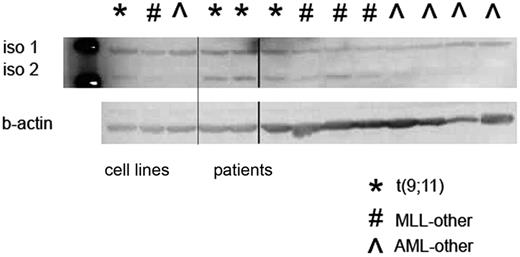 Figure 3. Protein expression analysis of IGSF4 with Western blot. Sections of Western blot showing data from 3 cell lines and 10 patient samples. Two described isoforms (iso 1 and iso 2) are shown at 48 kDa and 45 kDa, respectively. Bottom panel shows loading control with beta-actin. The protein expression of IGSF4 isoform 2 in patients with a MLL t(9;11) is greater than protein expression of IGSF4 isoform 2 in the other groups. The first lane shows the ladder, the other lanes contain cell lysates from cell lines and patients (separated by the thin line). At the thick line, one lane was spliced out.