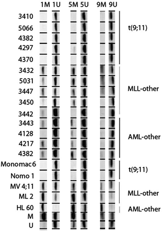 Figure 4. Methylation status of IGSF4 tested by MS-PCR. Figure showing results of MS-PCR in AML patients and cell lines. Three separate regions of the promoter were investigated; region 1, 5, and 9. Each column shows results for a specific primer pair (M, methylated; U, unmethylated). The top of the figure shows the IGSF4 methylation status of several patients (indicated by number), and the bottom shows methylation status of cell lines and M and U control DNA. On the left the identity of each sample is indicated, and on the right the cytogenetic group each patient or cell line belongs to is shown. In patients with t(9;11) (n = 5), no bands are seen with the methylated-specific primers and heavy bands are seen with the unmethylated-specific primers. In contrast, the other MLL patients (n = 5) and other AML patients (n = 5) do show a band with the methylated primer. This difference is also seen in the cell lines.