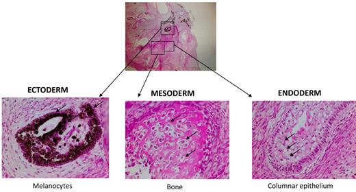 Figure 3. Nonhematopoietic differentiation of MPS-iPS cells. Same histologic section of mature teratoma from immunodeficient mouse injected with MPS-iPS cells (top, magnification 4×) shows melanocytes of ectodermal origin (bottom left arrows), osteoid deposition and osteocytes of medodermal origin (bottom middle arrows), columnar epithelium of endodermal origin (bottom right; goblet cells are indicated by arrows; magnification 20×). Similar mature teratomas with contribution of ectodermal, mesodermal, and endodermal-derived cells formed after injection of early (< 20) passage and late (> 20) passage iPS cells from wild-type keratinocytes and MSCs (n = 11), from patient 1 (keratinocyte-derived iPS cells, n = 3; IDUA-corrected keratinocyte-derived iPS cells, n = 3) and from patient 2 (keratinocyte-derived iPS cells, n = 2; MSC-derived iPS cells, n = 2; data not shown). Hematoxylin-eosin stain. Images were obtained with an Olympus BX51 Microscope, magnification 4×/0.16 and 20×/0.70. Spot RT camera and Spot RT software v3.2 were used in acquiring the images. All images were taken at room temperature.
