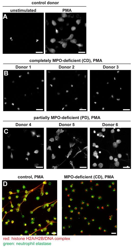Figure 1. MPO is required for NET formation. Neutrophils were activated with PMA for 4-6 hours to stimulate NET formation, then stained with the DNA dye Sytox green (A-C) or (D) immunostained with antibodies against the histone H2A/H2B/DNA complex (red) and neutrophil elastase (green). (A) Neutrophils from a control donor formed NETs after PMA stimulation, and naive cells had small, condensed nuclei. (B) Neutrophils from completely MPO-deficient donors did not form NETs, as indicated by their condensed nuclei similar to those of unstimulated neutrophils. (C) Partially MPO-deficient neutrophils made NETs. (D) Extracellular DNA released from control neutrophils stained with antibodies against chromatin and neutrophil elastase, 2 known NET components. In completely MPO-deficient neutrophils, as in naive neutrophils,20 neutrophil elastase was localized in granules and chromatin remained condensed. Experiments with CD neutrophils were repeated at least 6 times with 3 independent, unrelated donors. Experiments with PD neutrophils were repeated at least 3 times with 3 independent, unrelated donors. Scale bar, 25 μm.
