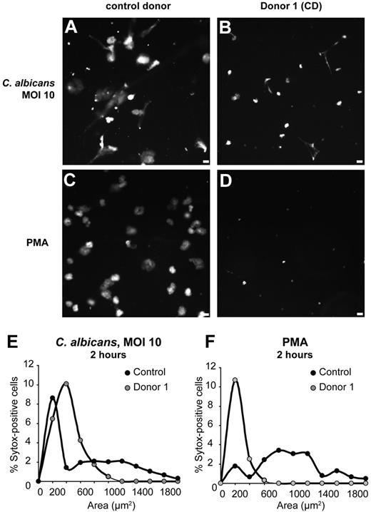 Figure 3. NET formation in response to C albicans is impaired in MPO-deficient neutrophils. Neutrophils were co-incubated with the yeast form of C albicans at an MOI of 10, or activated with PMA, for 2 hours, and DNA was stained with Sytox. (A-D) Images of Sytox fluorescence. (E-F) Quantitation of nuclear areas. Neutrophils from a healthy donor formed NETs upon stimulation with C albicans (A,E) and PMA (C,F), but neutrophils from a completely MPO-deficient donor (donor 1) did not form NETs in response to C albicans (B,E) or PMA (D,F). Scale bar, 25 μm.