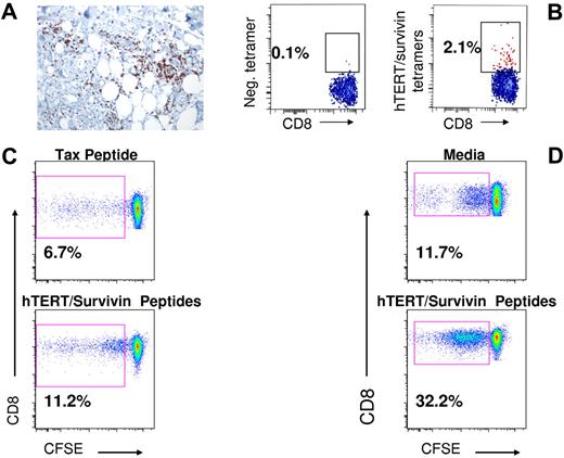 Figure 4. Functional immune responses in specific patients. (A) Deep skin biopsy of ≥ 5-cm area of induration (from patient MD012) showing CD8+/CD3+ T-cell infiltrate. (B) Tetramer analysis of T cells extracted from the skin biopsy depicted in panel A; 2.1% of the cells analyzed exhibited hTERT/survivin tetramer staining versus 0.1% in the control (tetramer negative) sample. (C) Proliferative response of CD8+ T cells (from patient UPCC/13406-11) after stimulation with hTERT/survivin peptide mix by CFSE dilution analysis; percentage of CFSEdim was 11.2% in the hTERT/survivin-stimulated cells (bottom) versus 6.67% in cells stimulated with an irrelevant peptide derived from the Tax protein (top) and 6.2% in cells exposed to medium only (data not shown). (D) Proliferative response of CD8+ T cells from a second immunized patient (UPCC/13406-22) after stimulation with hTERT/survivin peptide mix by CFSE dilution analysis; percentage of CFSEdim was 33.2% in the hTERT/survivin-stimulated cells (bottom) versus 11.7% in cells that were incubated in media only without peptide stimulation (top).