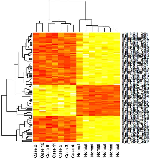 Figure 2. Clustering of the top 96 genes (P < .05, FWER) differentially expressed between the tumor group and normal group shows a distinct separation between the groups.